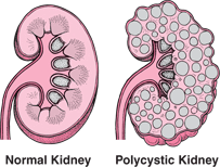 Image result for Congenital polycystic kidney