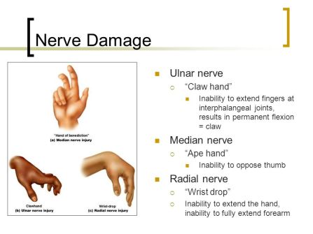 Image result for hand of benediction
claw hand, ape hand, wrist drop