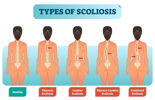 Types of scoliosis