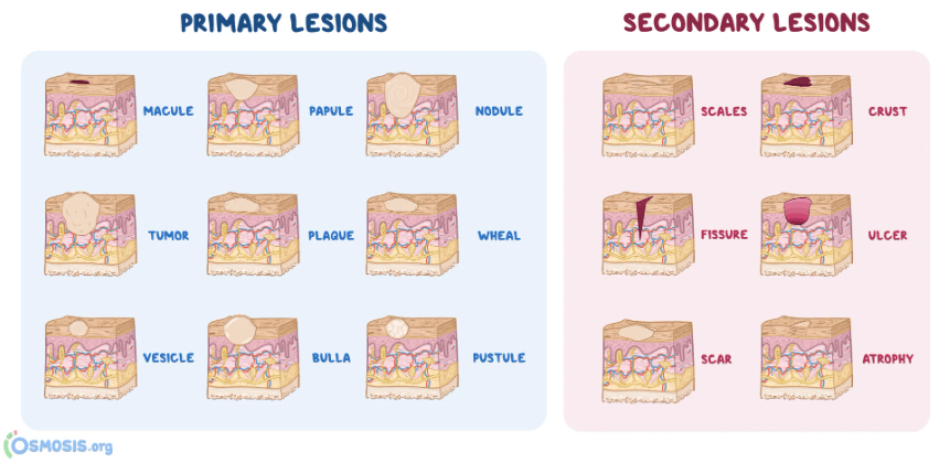 Primary and secondary skin lesions