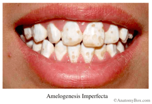 Amelogenesis imperfecta