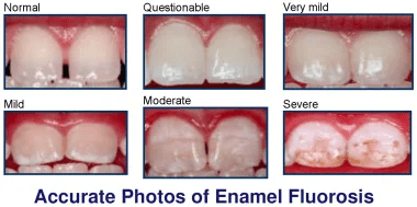 enamel fluorosis