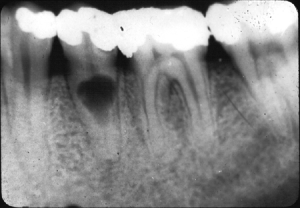 internal resorption