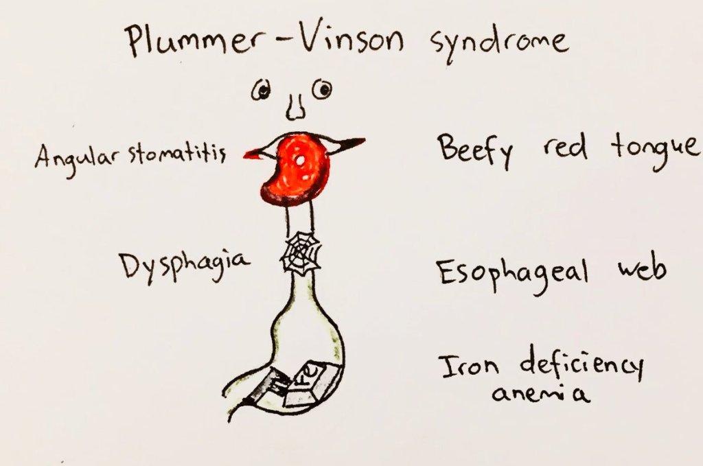 Plummer vinson syndrome clinical presentation
