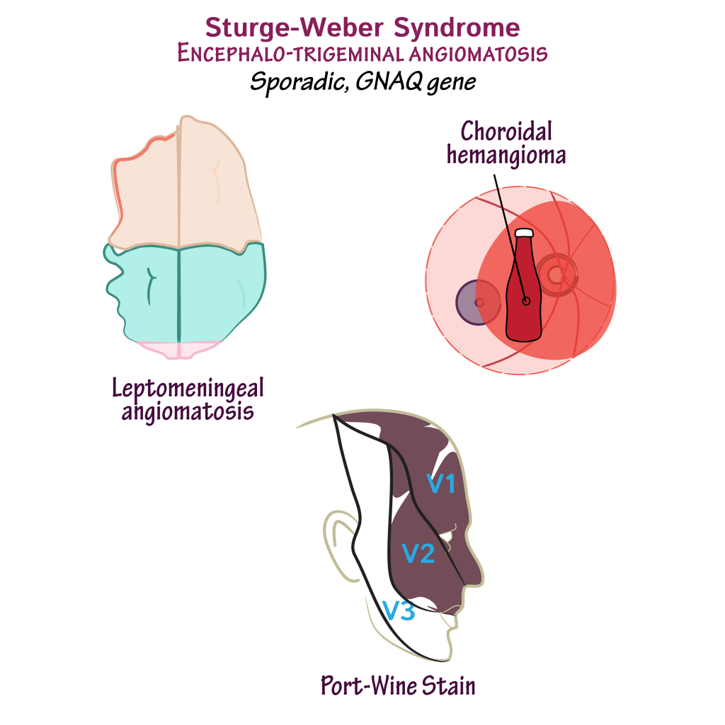 Struge weber syndrome