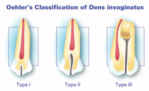 Dens invaginatus type I, II and III