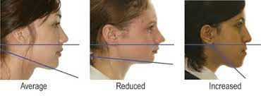 Vertical facial relationship
