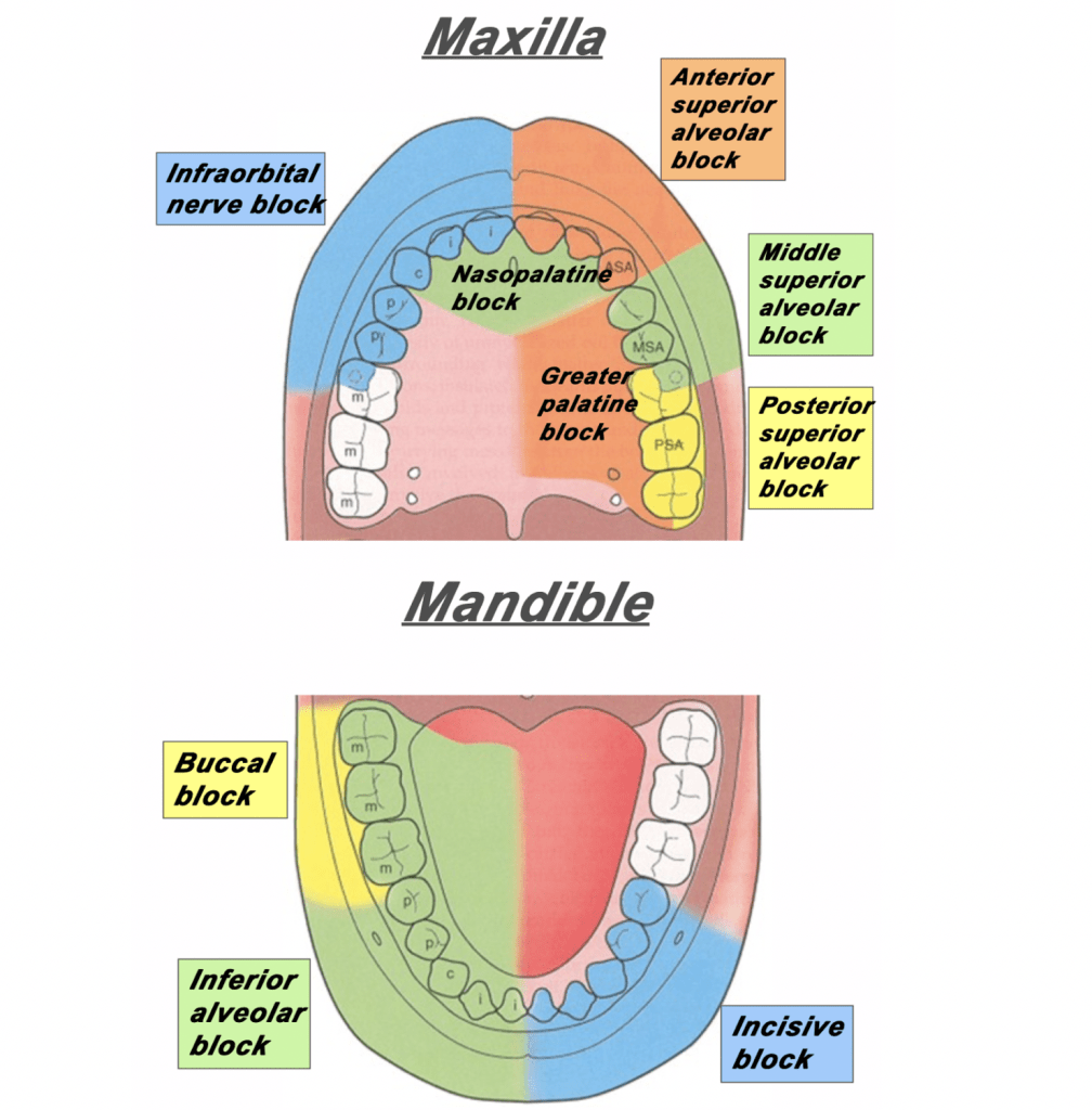 Nerve block in maxilla and mandible