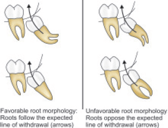 Impacted tooth root curvature - favorable/unfavorable