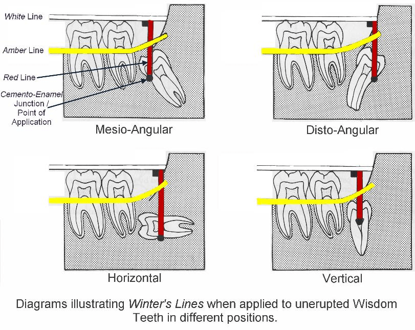 Winter's lines third molar impacted