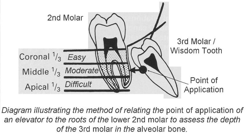 Impacted third molar, use second molar relation