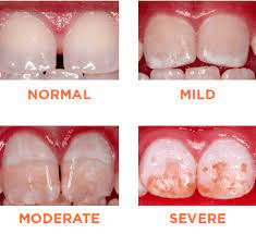 Dental fluorosis