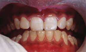 Chronological hypoplasia (Linear enamel hypoplasia)