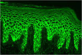 Immunofluorescence of pemphigus vulgaris