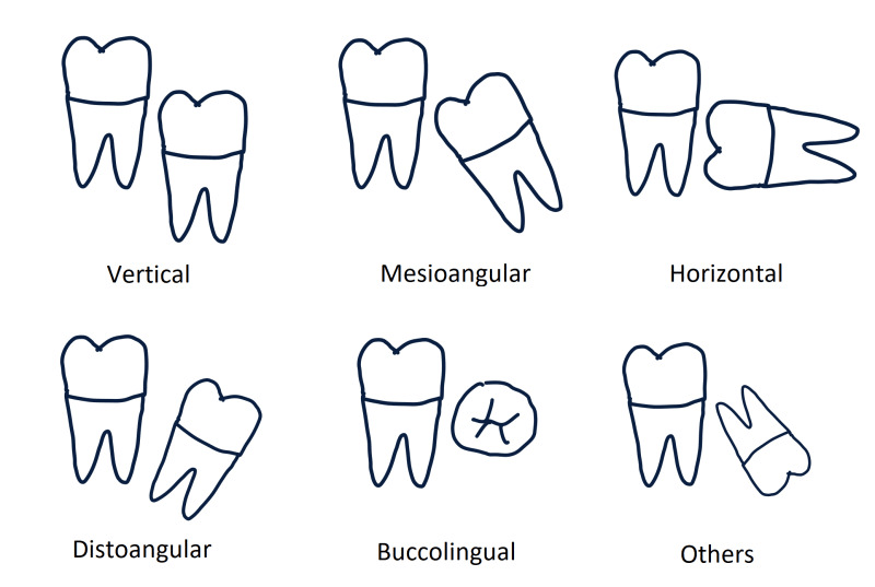 Angulation of impacted molar